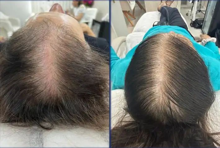 Antes e depois protocolo combinado queda capilar — Salvador-BA